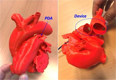 Impact of 3D-printed models in meetings with parents of children undergoing interventional cardiac catheterisation